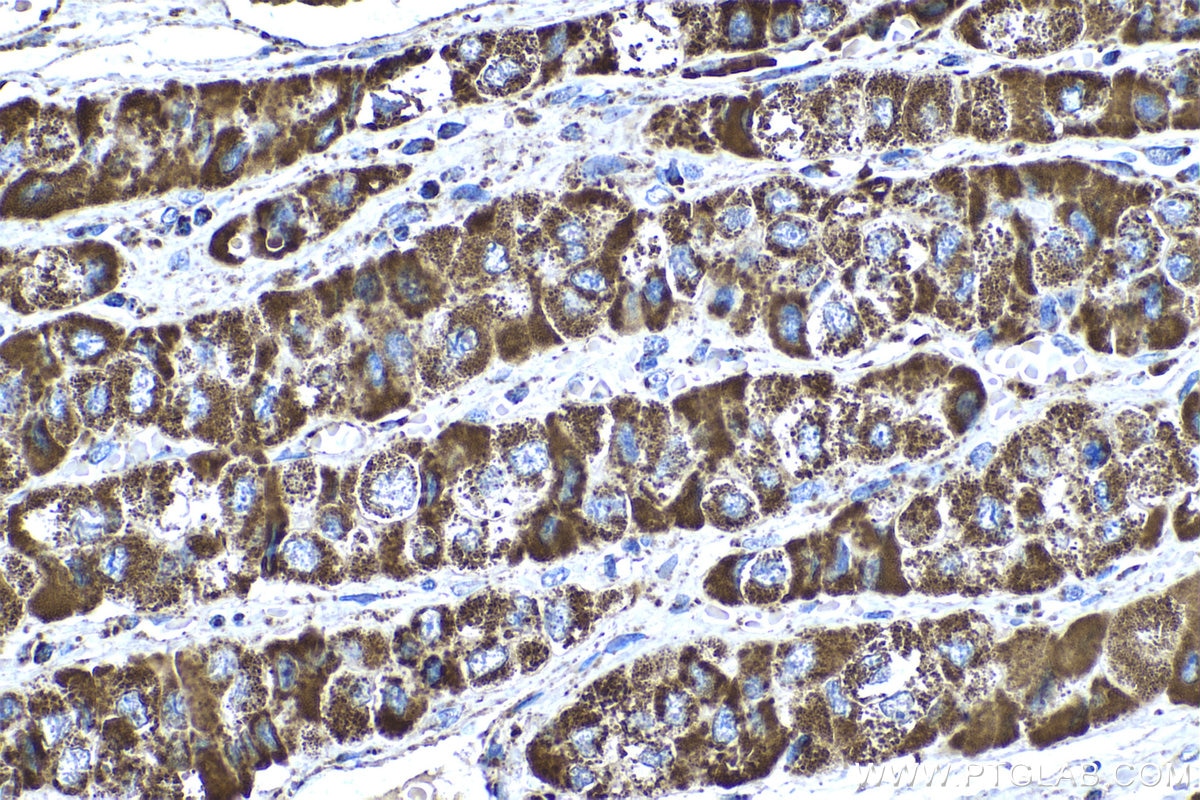 Immunohistochemistry (IHC) staining of human liver cancer tissue using ATP5A1 Monoclonal antibody (66037-1-Ig)