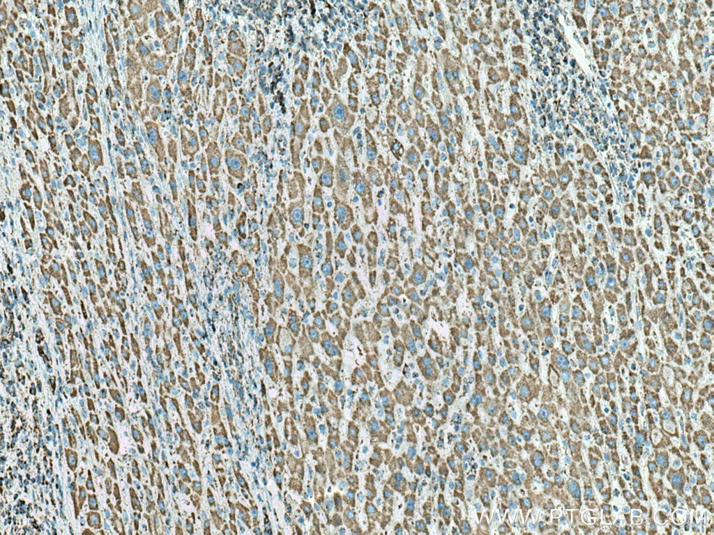 IHC staining of human liver cancer using 10910-1-AP