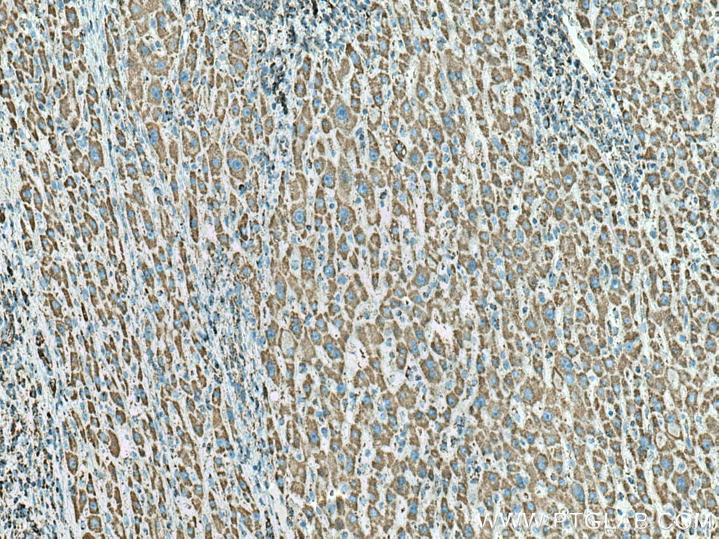 Immunohistochemistry (IHC) staining of human liver cancer tissue using ATP5C1 Polyclonal antibody (10910-1-AP)