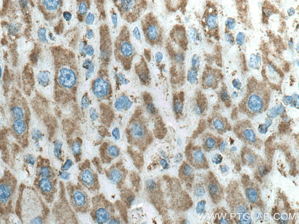 Immunohistochemistry (IHC) staining of human liver cancer tissue using ATP5C1 Polyclonal antibody (10910-1-AP)