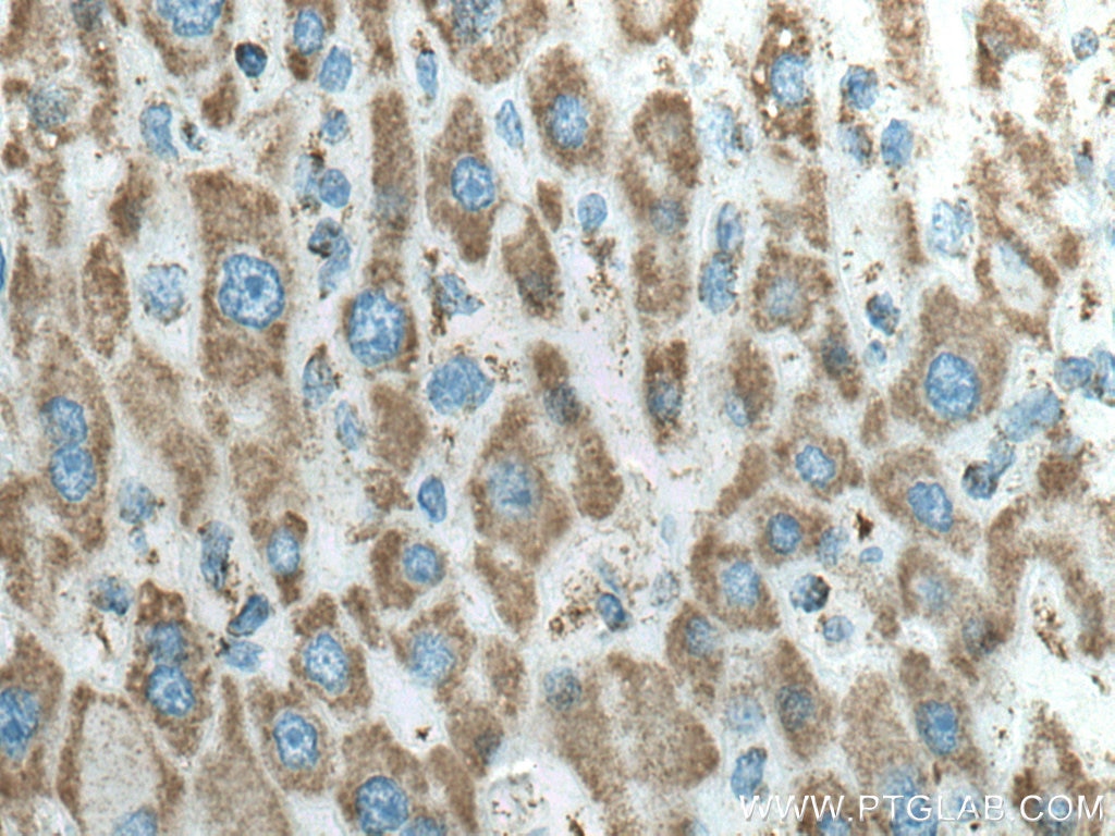 IHC staining of human liver cancer using 10910-1-AP