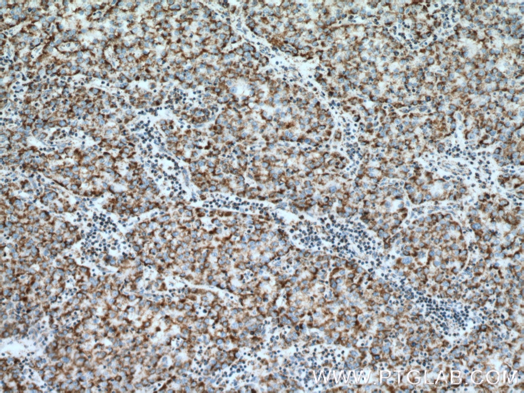 Immunohistochemistry (IHC) staining of human liver cancer tissue using ATP5C1 Monoclonal antibody (60284-1-Ig)