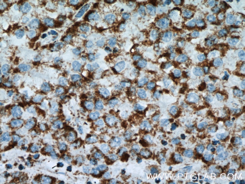 Immunohistochemistry (IHC) staining of human liver cancer tissue using ATP5C1 Monoclonal antibody (60284-1-Ig)