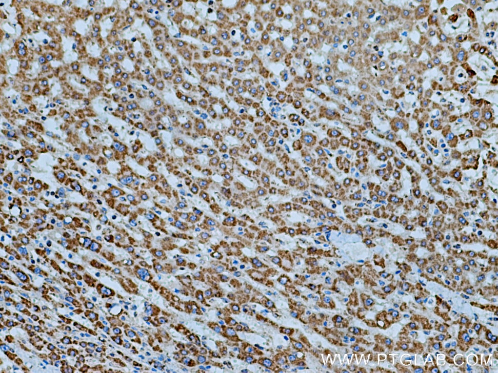 Immunohistochemistry (IHC) staining of human liver cancer tissue using ATP5D Polyclonal antibody (14893-1-AP)