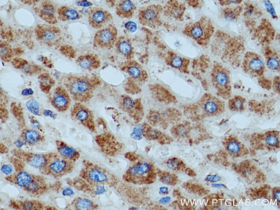 Immunohistochemistry (IHC) staining of human liver cancer tissue using ATP5D Polyclonal antibody (14893-1-AP)