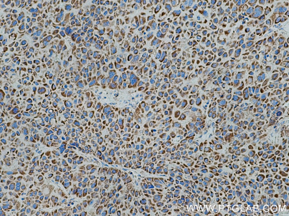 IHC staining of human liver cancer using 14893-1-AP