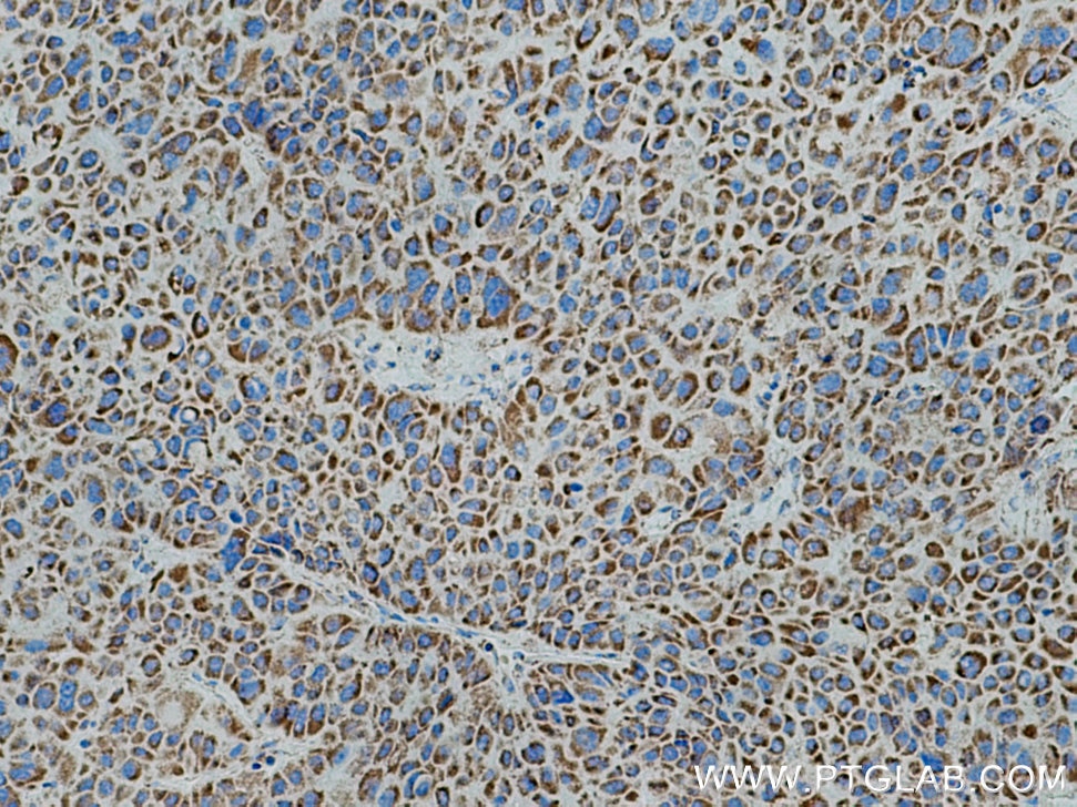 Immunohistochemistry (IHC) staining of human liver cancer tissue using ATP5D Polyclonal antibody (14893-1-AP)