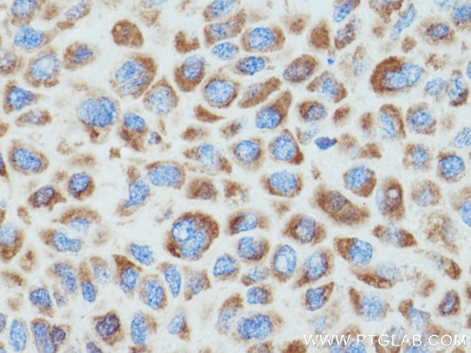 Immunohistochemistry (IHC) staining of human liver cancer tissue using ATP5D Polyclonal antibody (14893-1-AP)