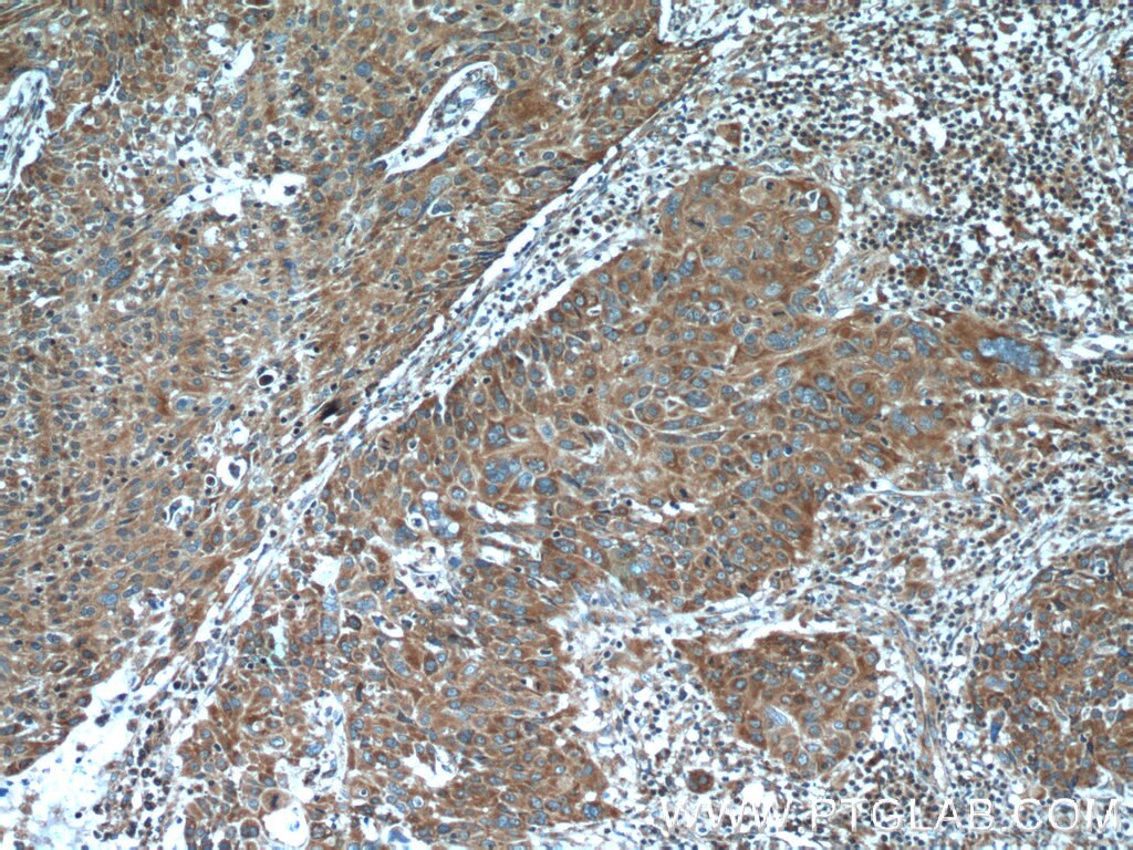 Immunohistochemistry (IHC) staining of human lung cancer tissue using ATP5D Polyclonal antibody (14893-1-AP)