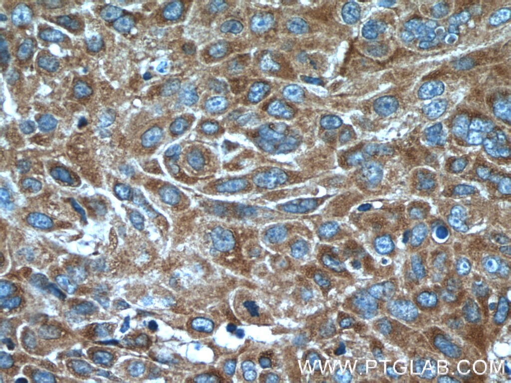 IHC staining of human lung cancer using 14893-1-AP