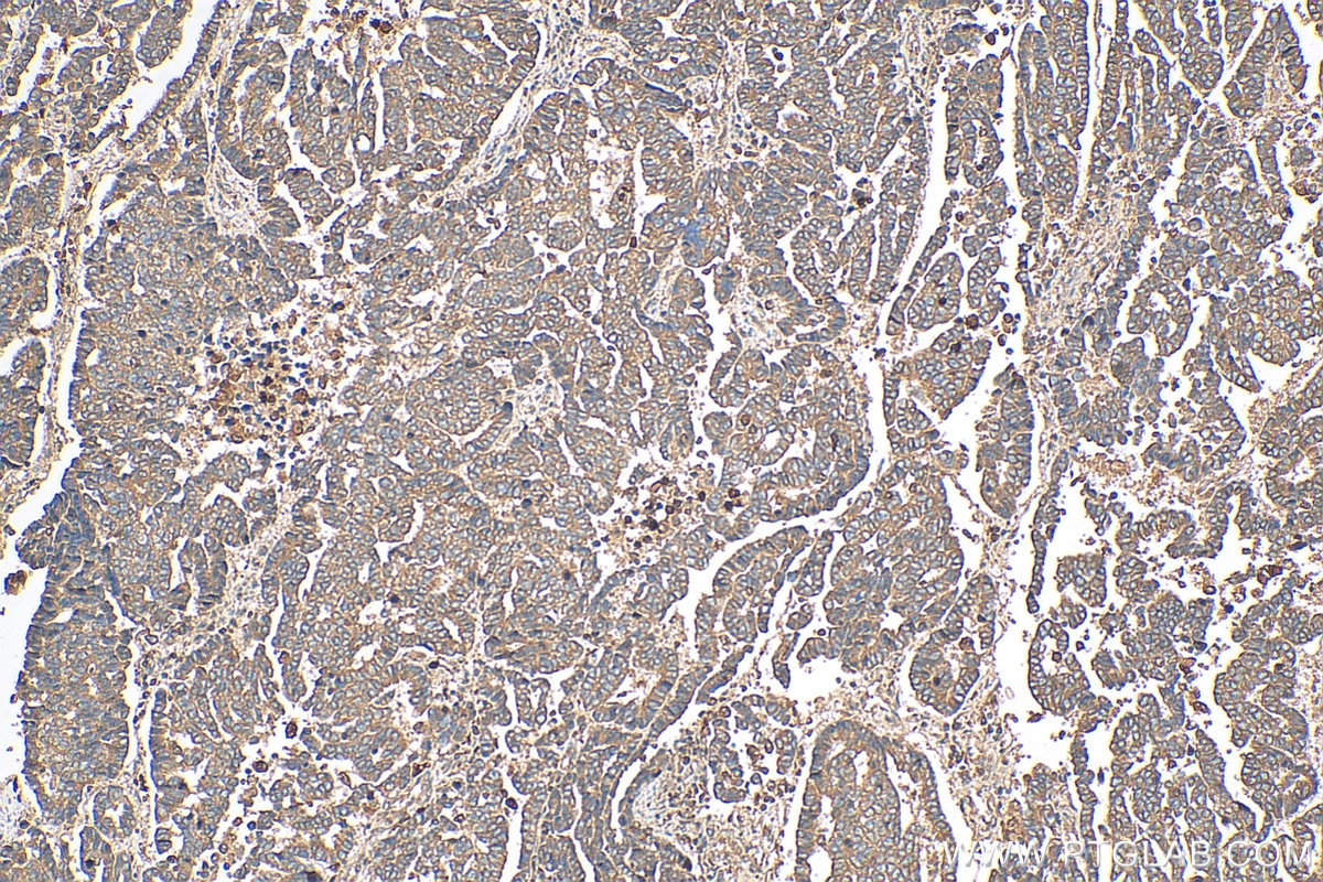 Immunohistochemistry (IHC) staining of human ovary tumor tissue using ATP5G3 Polyclonal antibody (21662-1-AP)