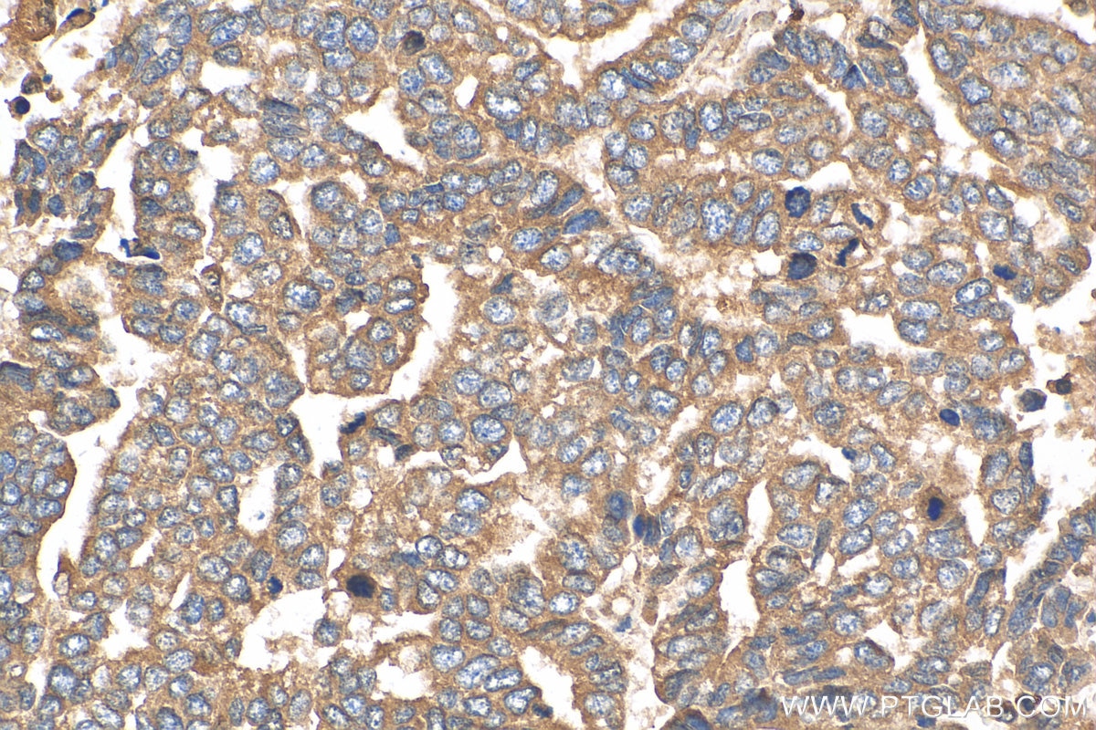 Immunohistochemistry (IHC) staining of human ovary tumor tissue using ATP5G3 Polyclonal antibody (21662-1-AP)