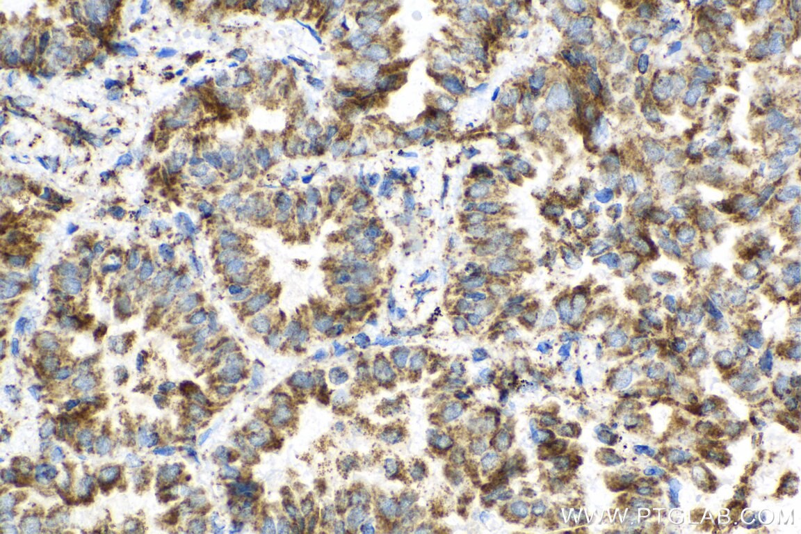 Immunohistochemistry (IHC) staining of human lung cancer tissue using ATP5H Polyclonal antibody (17589-1-AP)