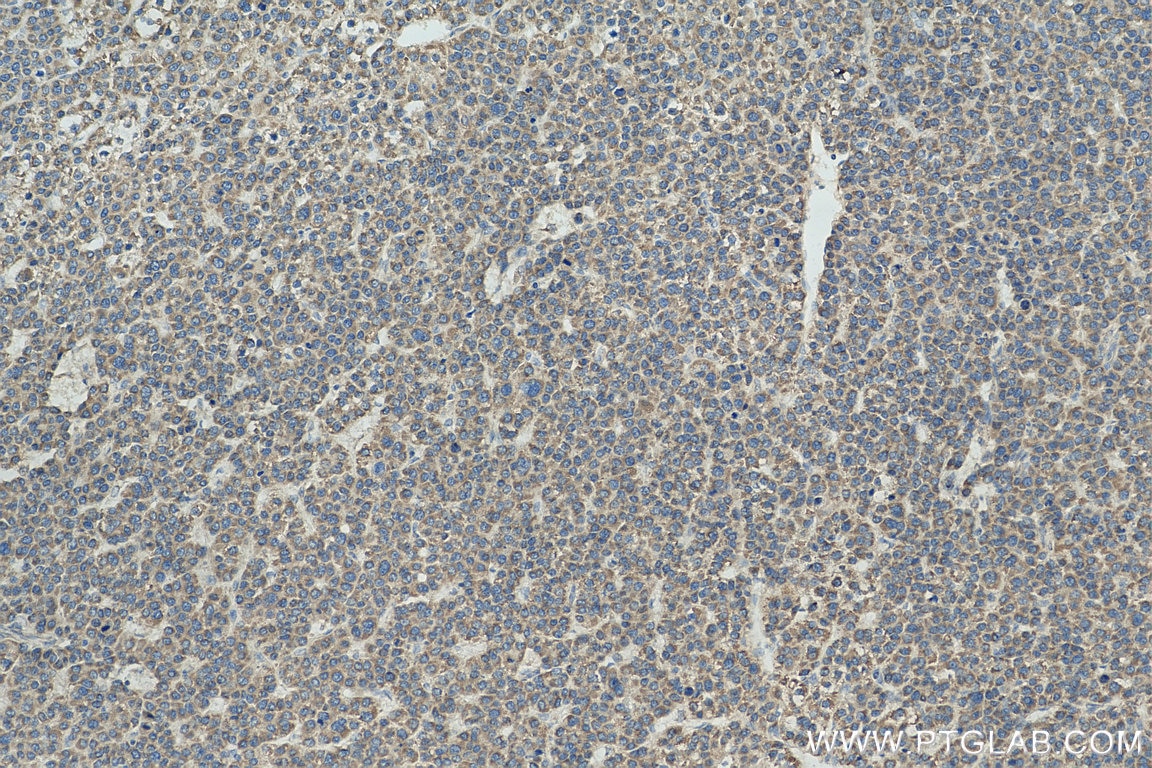 Immunohistochemistry (IHC) staining of human liver cancer tissue using ATP5I Polyclonal antibody (16483-1-AP)