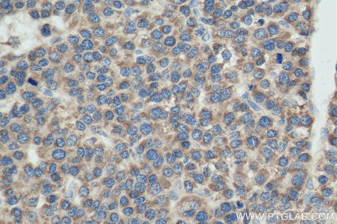 Immunohistochemistry (IHC) staining of human liver cancer tissue using ATP5I Polyclonal antibody (16483-1-AP)