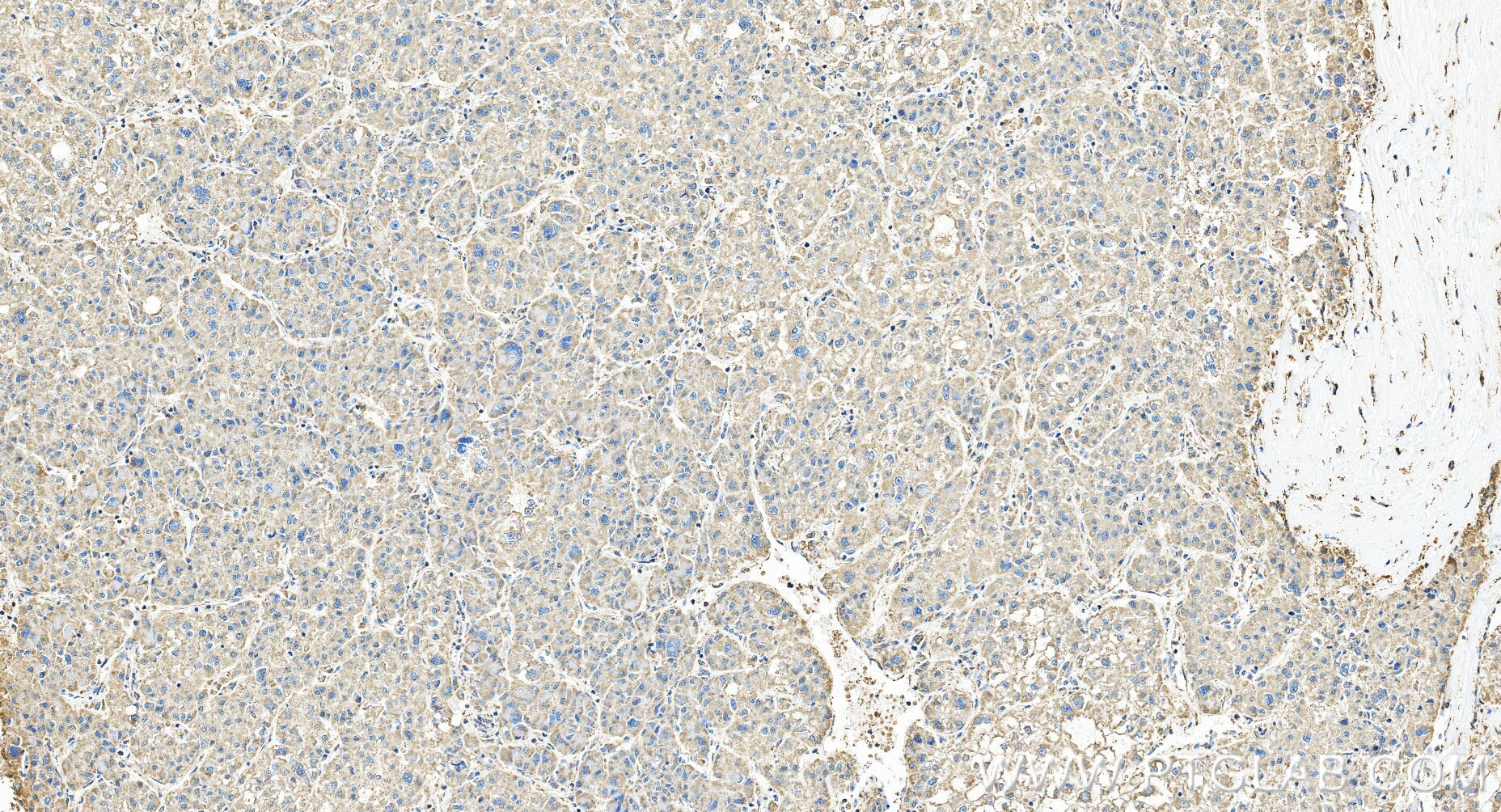 Immunohistochemistry (IHC) staining of human liver cancer tissue using ATP5I Recombinant monoclonal antibody (86218-2-RR)