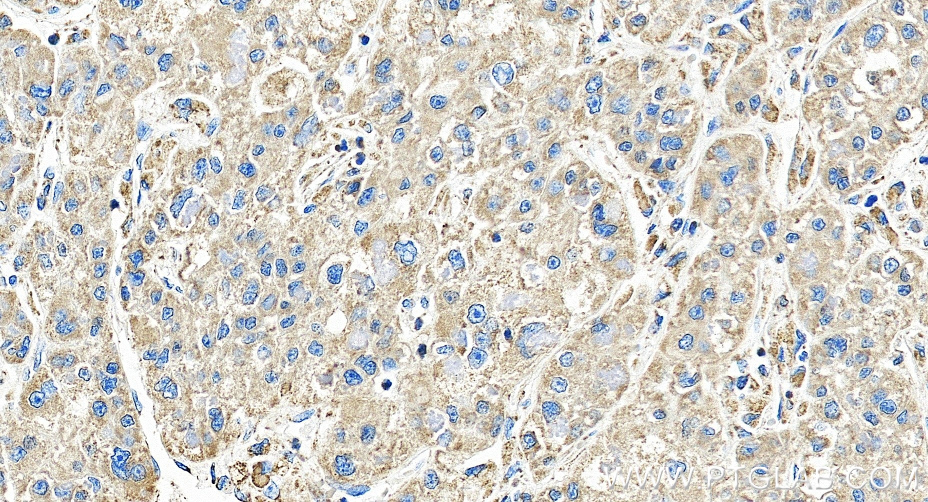 Immunohistochemistry (IHC) staining of human liver cancer tissue using ATP5I Recombinant monoclonal antibody (86218-2-RR)