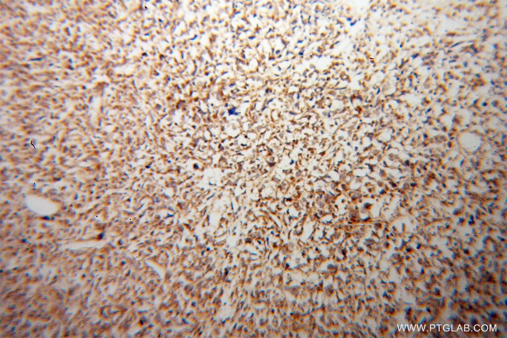 Immunohistochemistry (IHC) staining of human osteosarcoma tissue using ATP5J Polyclonal antibody (14114-1-AP)