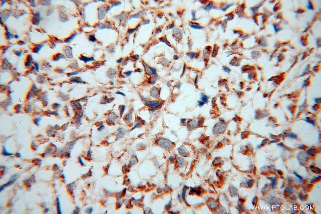 Immunohistochemistry (IHC) staining of human osteosarcoma tissue using ATP5J Polyclonal antibody (14114-1-AP)