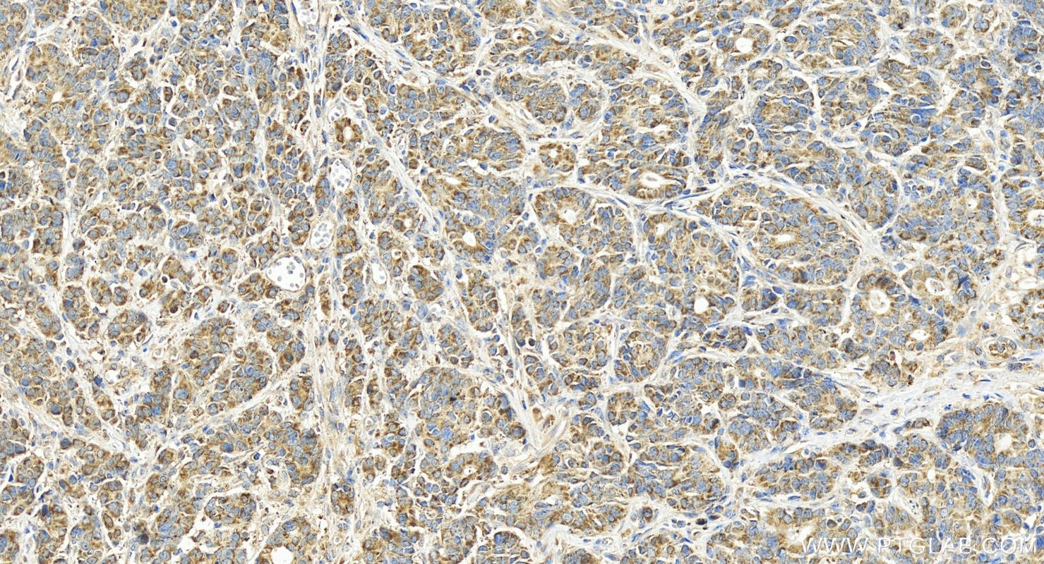 Immunohistochemical analysis of paraffin-embedded human stomach cancer tissue slide using 16307-1-AP (ATP5L antibody) at dilution of 1:400 (under 20x lens). Heat mediated antigen retrieval with Tris-EDTA buffer (pH 9.0). Immunohistochemistry (IHC) staining of human stomach cancer tissue using ATP5L Polyclonal antibody (16307-1-AP)
