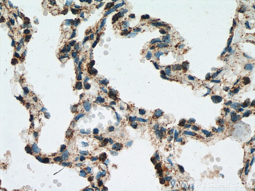 IHC staining of human lung cancer using 10994-1-AP