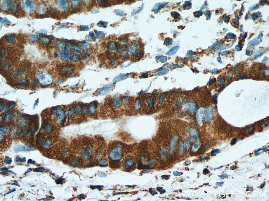 Immunohistochemistry (IHC) staining of human colon cancer tissue using ATP5O Polyclonal antibody (10994-1-AP)