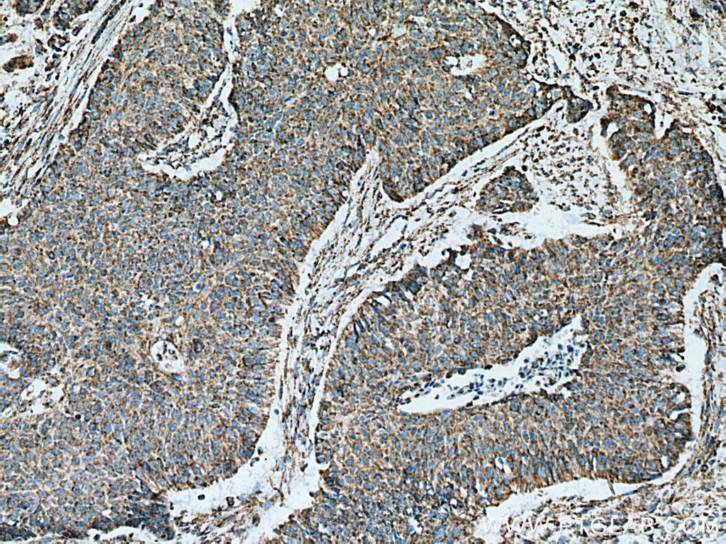 Immunohistochemistry (IHC) staining of human lung cancer tissue using ATP5O Polyclonal antibody (10994-1-AP)