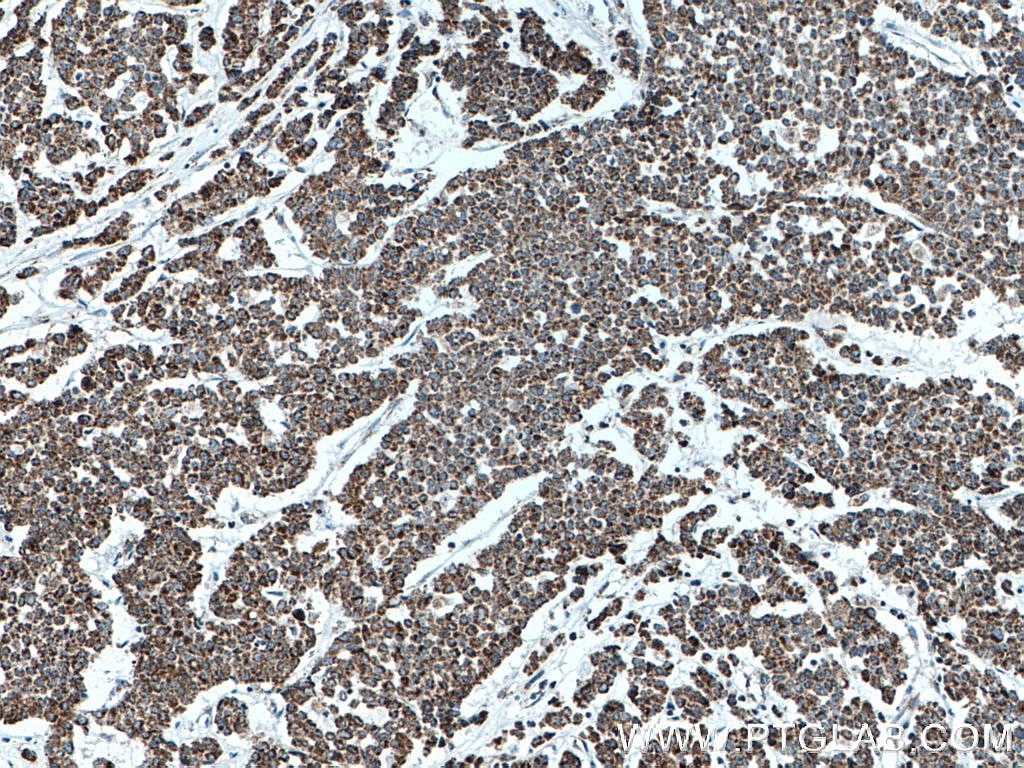 Immunohistochemistry (IHC) staining of human colon cancer tissue using ATP5O Monoclonal antibody (66696-1-Ig)