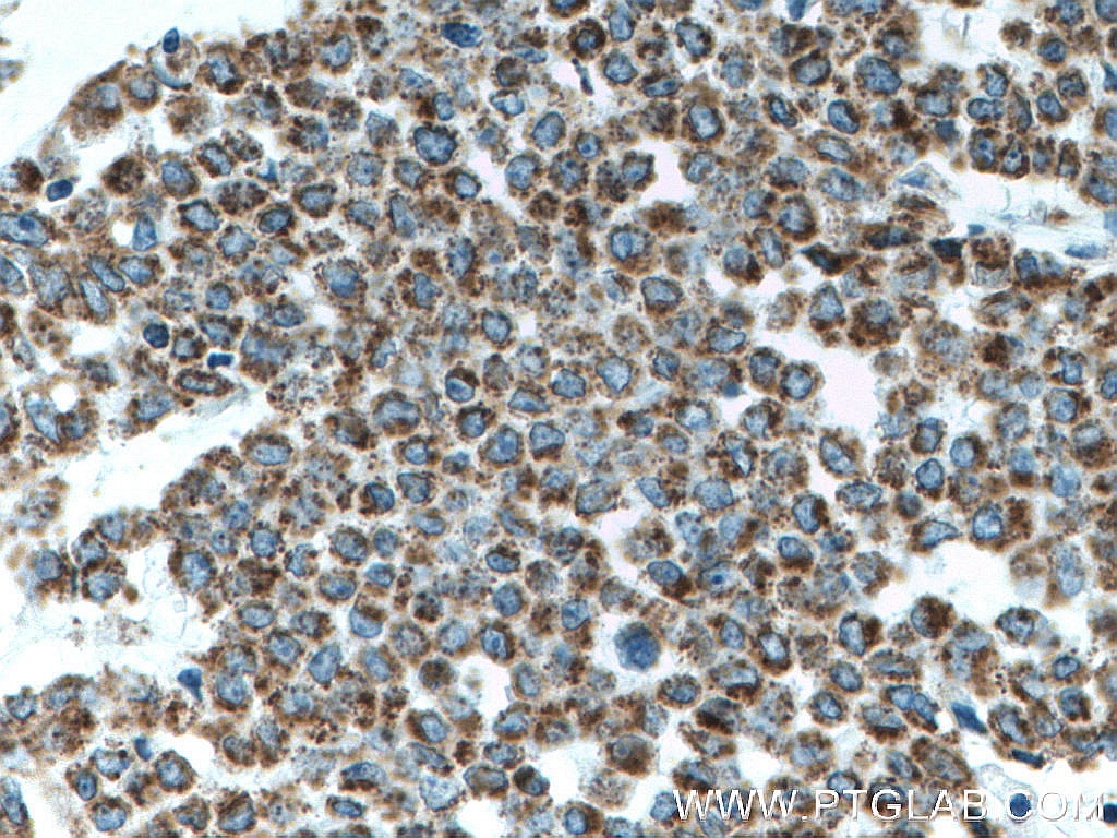 Immunohistochemistry (IHC) staining of human colon cancer tissue using ATP5O Monoclonal antibody (66696-1-Ig)