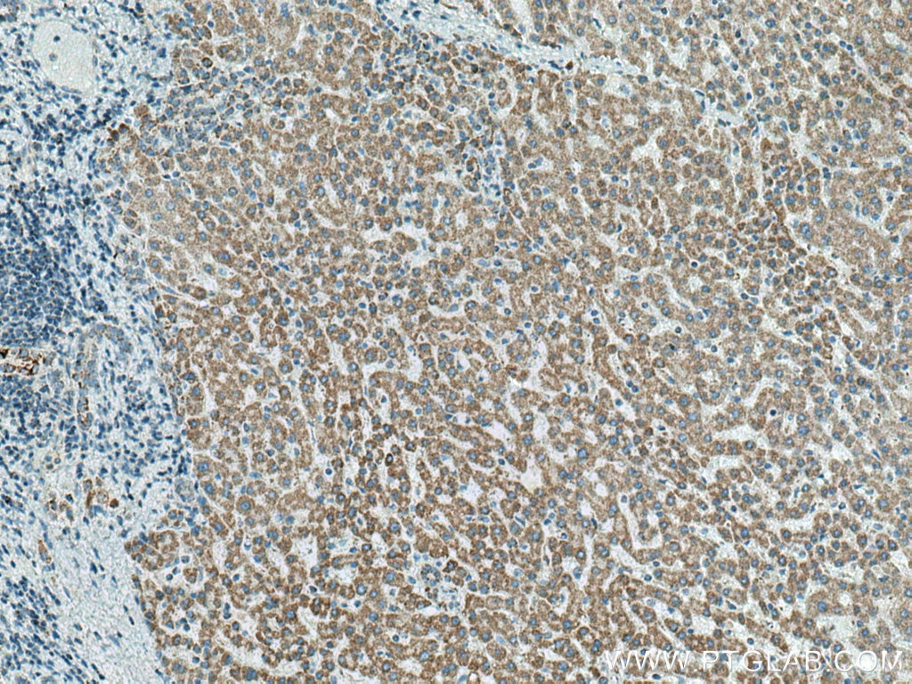 Immunohistochemistry (IHC) staining of human liver cancer tissue using ATP5O Monoclonal antibody (66696-1-Ig)