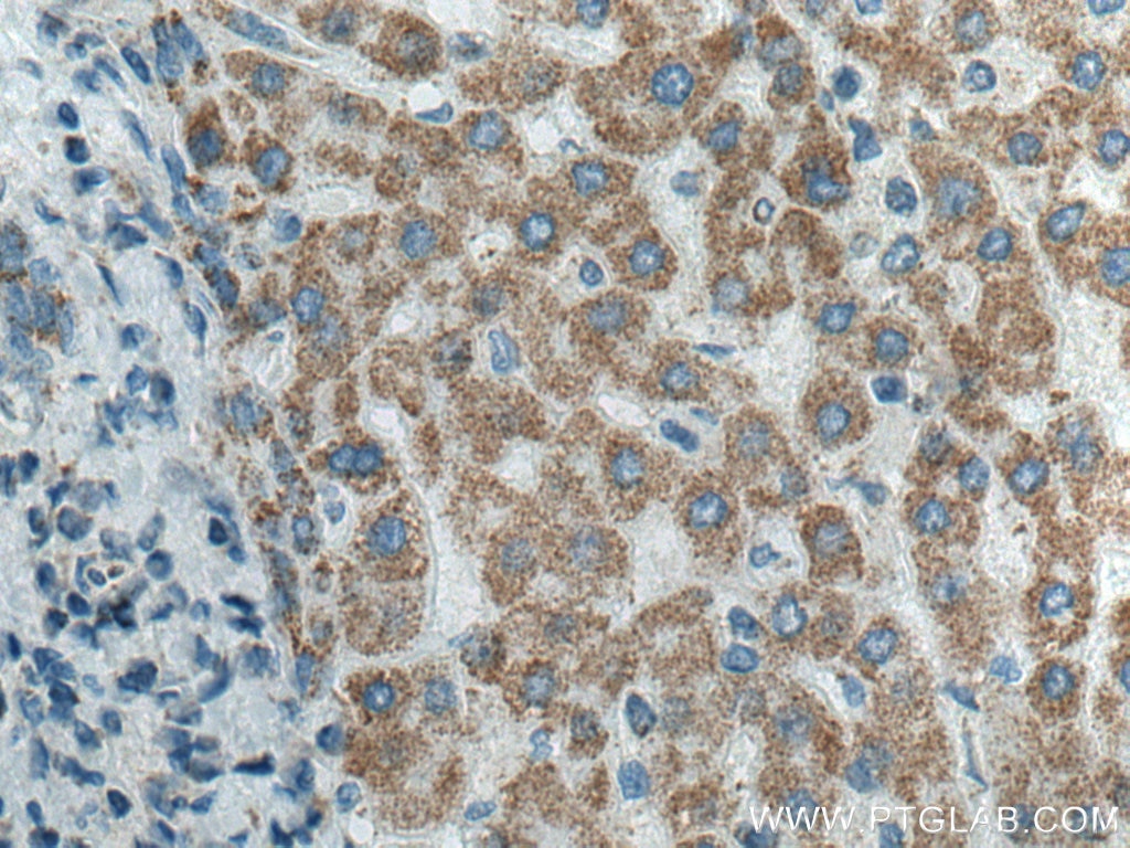 Immunohistochemistry (IHC) staining of human liver cancer tissue using ATP5O Monoclonal antibody (66696-1-Ig)