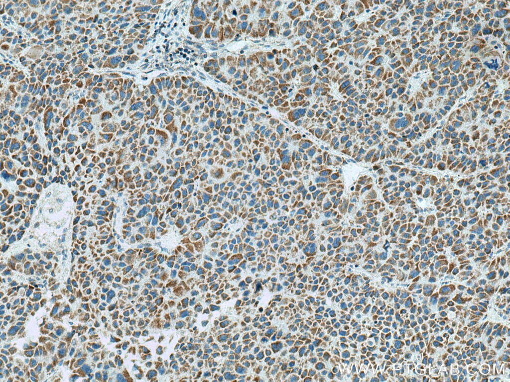 IHC staining of human liver cancer using 66696-1-Ig