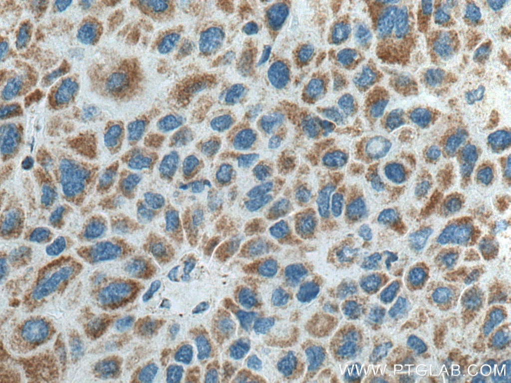 Immunohistochemistry (IHC) staining of human liver cancer tissue using ATP5O Monoclonal antibody (66696-1-Ig)