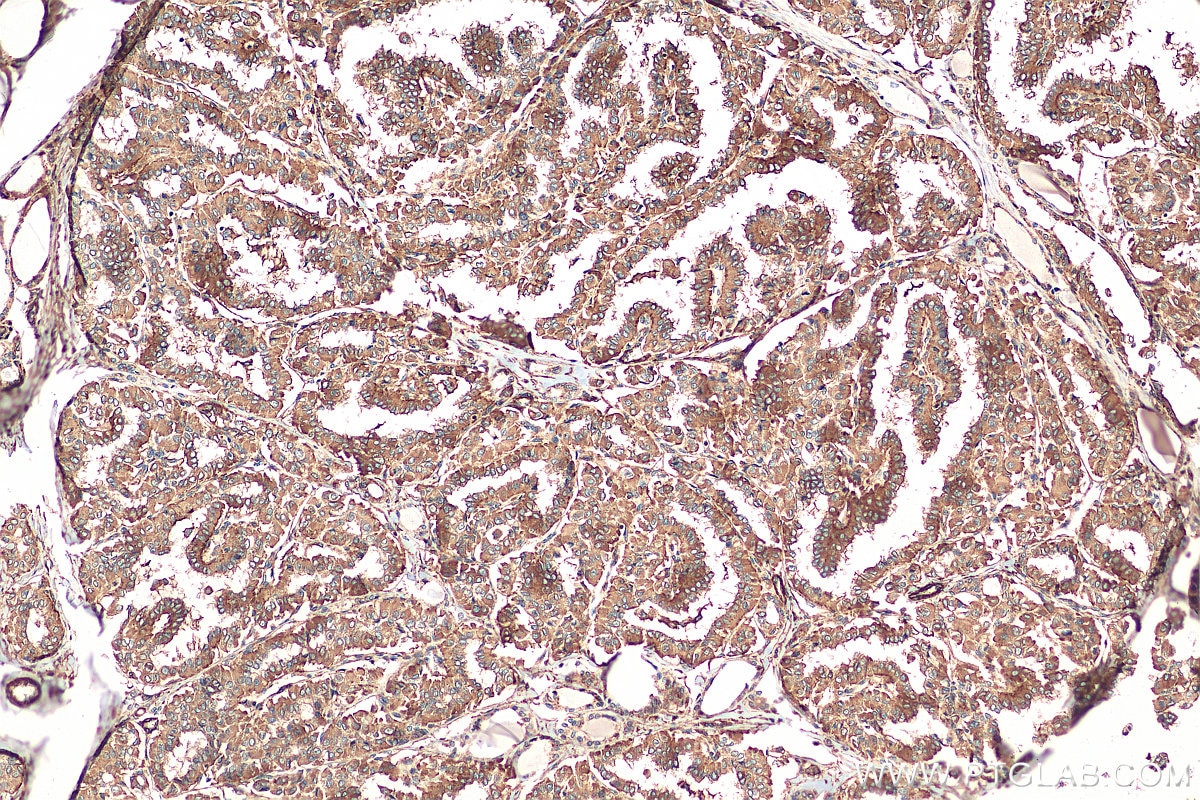 Immunohistochemistry (IHC) staining of human thyroid cancer tissue using ATP6V1A Polyclonal antibody (17115-1-AP)