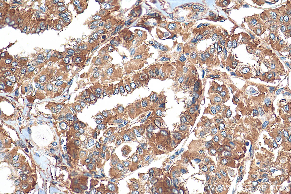 Immunohistochemistry (IHC) staining of human thyroid cancer tissue using ATP6V1A Polyclonal antibody (17115-1-AP)