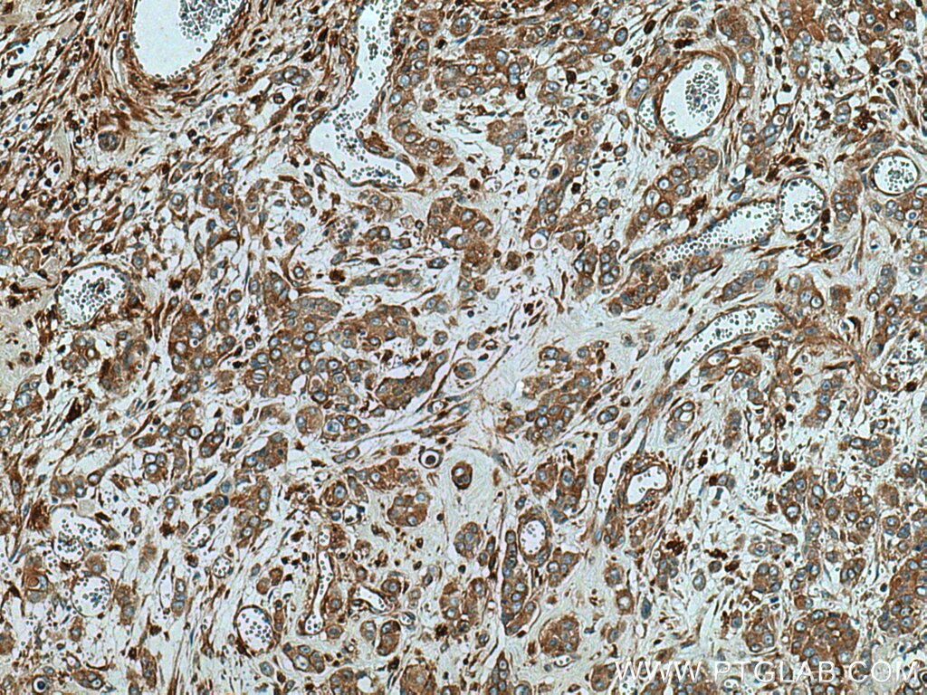 Immunohistochemistry (IHC) staining of human colon cancer tissue using ATP6V1B2 Polyclonal antibody (15097-1-AP)