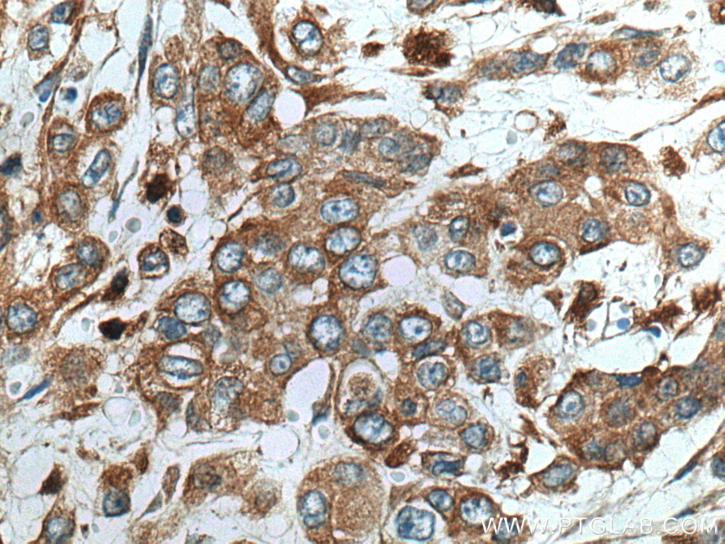 Immunohistochemistry (IHC) staining of human colon cancer tissue using ATP6V1B2 Polyclonal antibody (15097-1-AP)