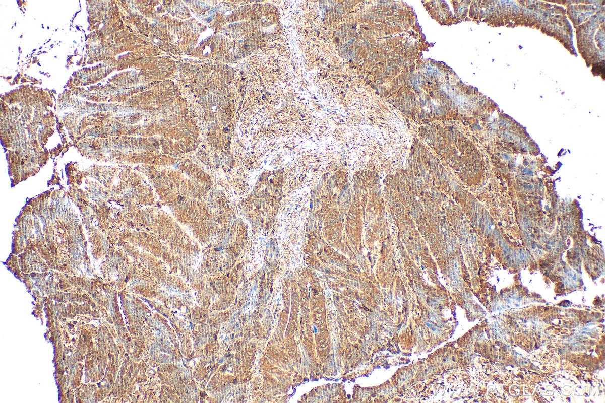 Immunohistochemistry (IHC) staining of human colon cancer tissue using ATP6V1B2 Polyclonal antibody (15097-1-AP)