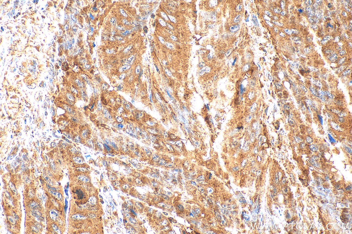 Immunohistochemistry (IHC) staining of human colon cancer tissue using ATP6V1B2 Polyclonal antibody (15097-1-AP)