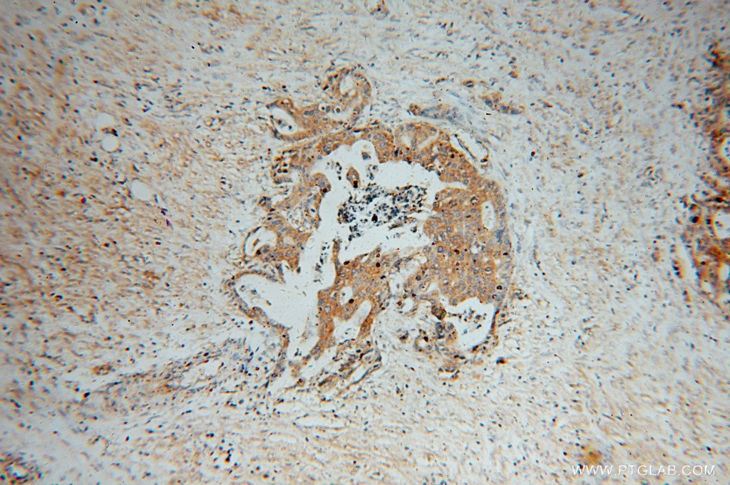 Immunohistochemistry (IHC) staining of human stomach cancer tissue using ATP6V1C1 Polyclonal antibody (16054-1-AP)