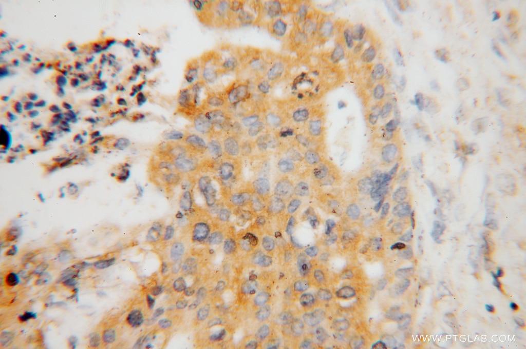 Immunohistochemistry (IHC) staining of human stomach cancer tissue using ATP6V1C1 Polyclonal antibody (16054-1-AP)