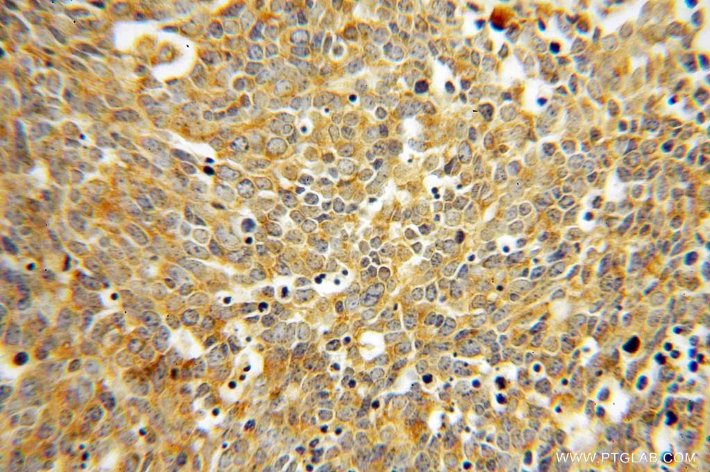 IHC staining of human lung cancer using 14920-1-AP