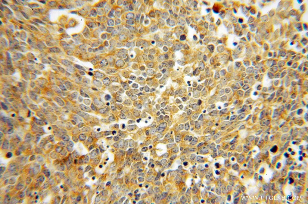 Immunohistochemistry (IHC) staining of human lung cancer tissue using ATP6V1D Polyclonal antibody (14920-1-AP)