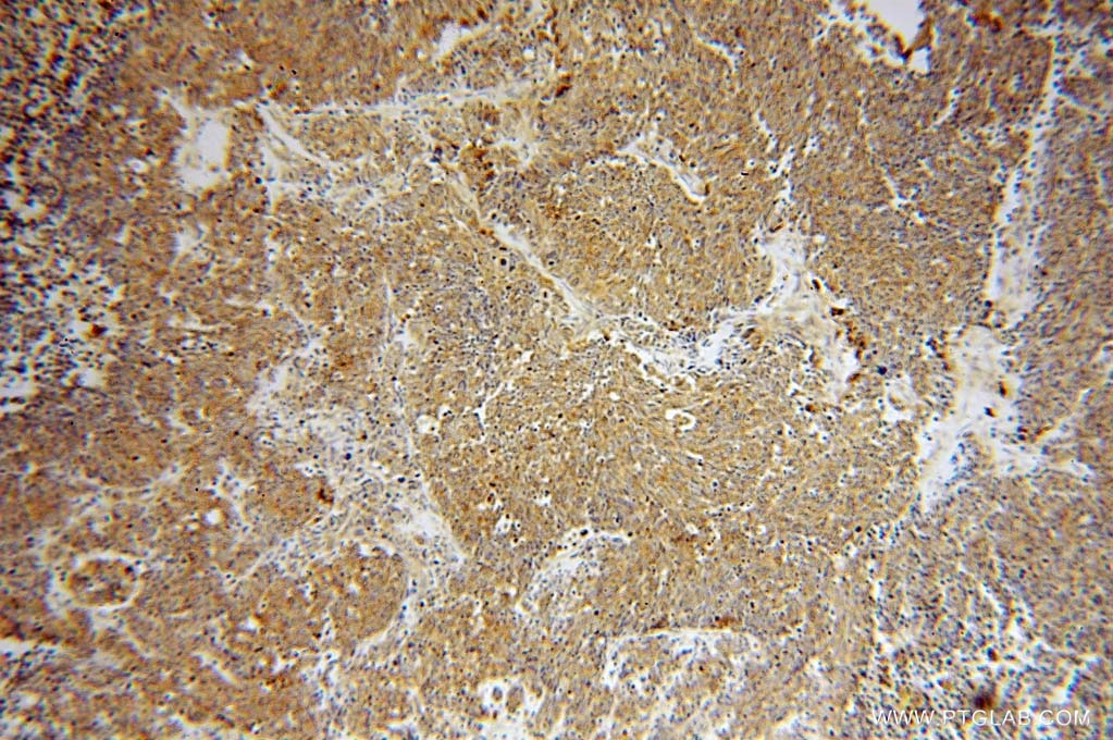 Immunohistochemistry (IHC) staining of human lung cancer tissue using ATP6V1D Polyclonal antibody (14920-1-AP)