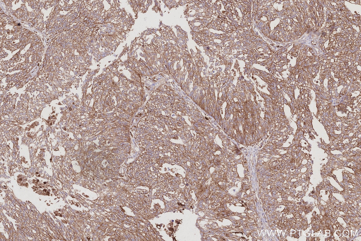 IHC staining of human ovary cancer using 68425-1-Ig Immunohistochemistry (IHC) staining of human ovary cancer tissue using ATP6V1H Monoclonal antibody (68425-1-Ig)