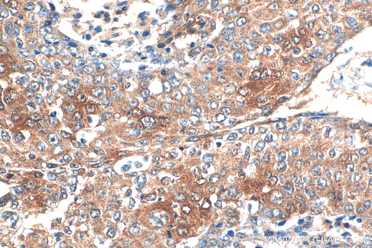 Immunohistochemistry (IHC) staining of human lung cancer tissue using ATP7A-Specific Polyclonal antibody (55375-1-AP)