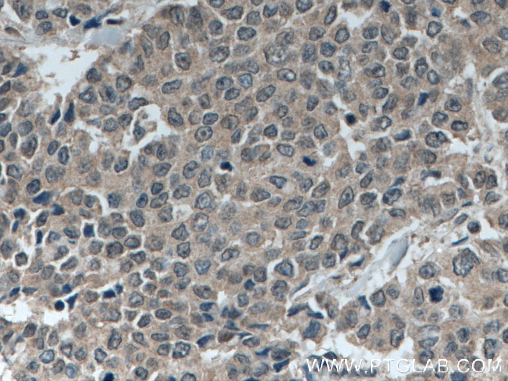 IHC staining of human colon cancer using 19786-1-AP