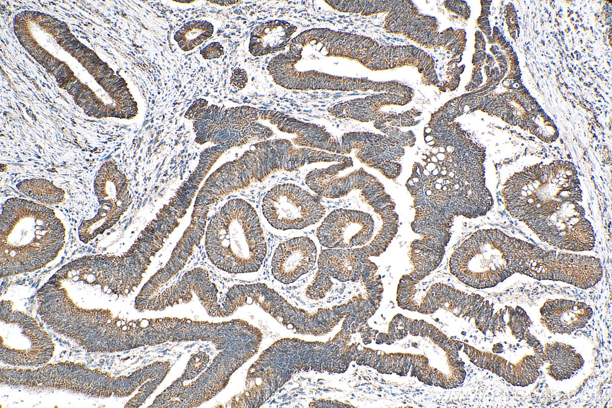 Immunohistochemistry (IHC) staining of human colon cancer tissue using ATP7B-Specific Polyclonal antibody (19786-1-AP)