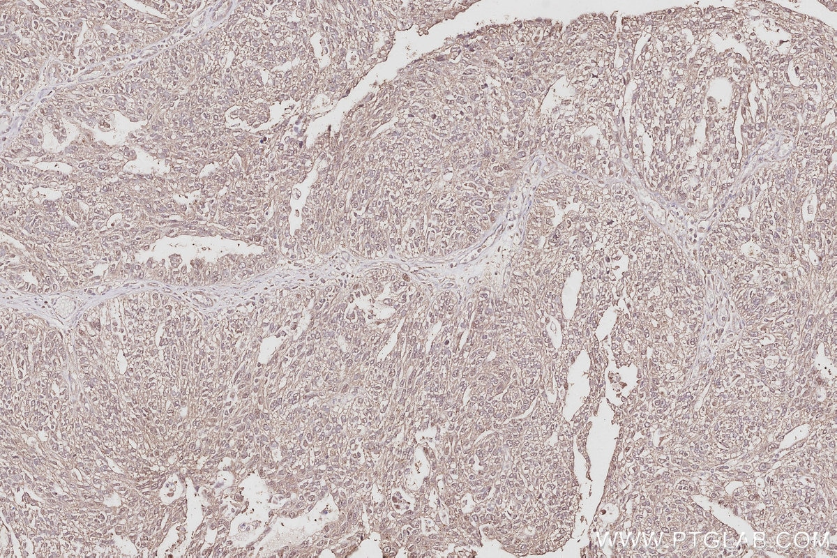 Immunohistochemistry (IHC) staining of human ovary cancer tissue using ATP8A1 Polyclonal antibody (21565-1-AP)