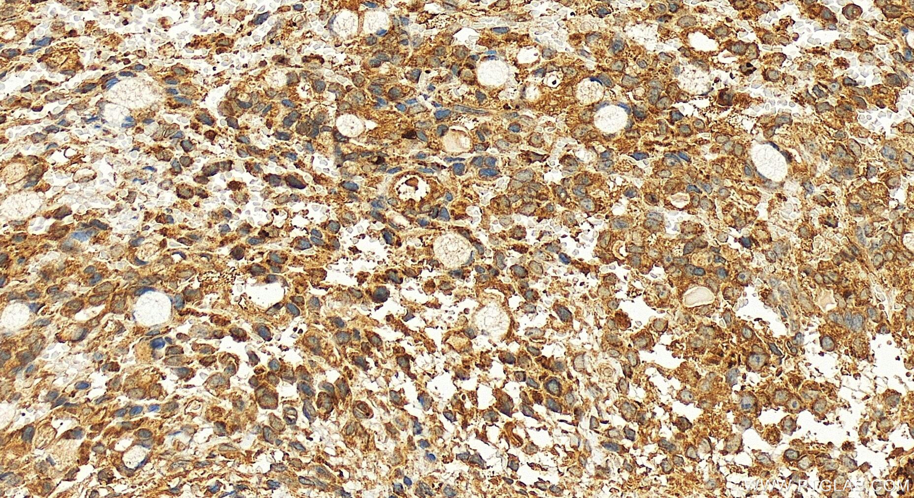 Immunohistochemistry (IHC) staining of human ovary cancer tissue using ATPAF1 Polyclonal antibody (18016-1-AP)